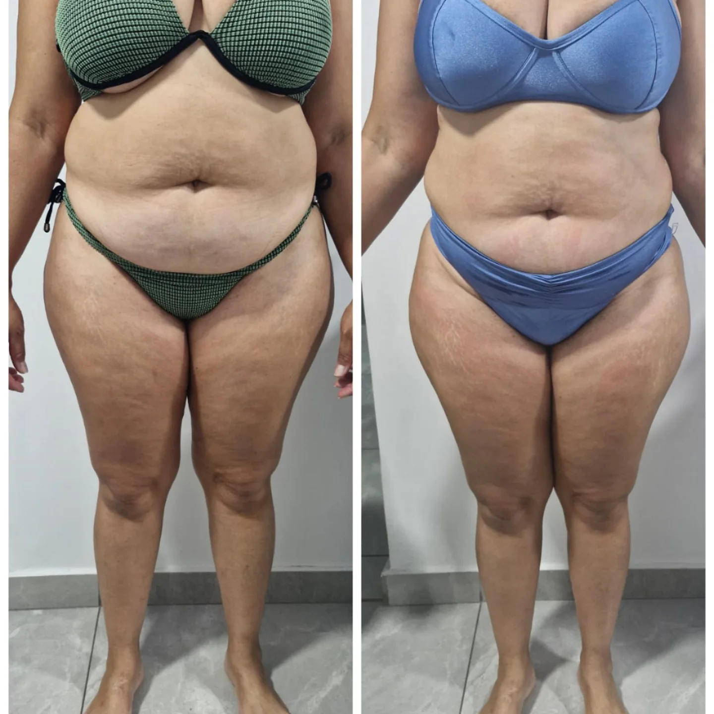 Antes e depois de tratamento corporal realizado na Clínica Flávia Rodrigues