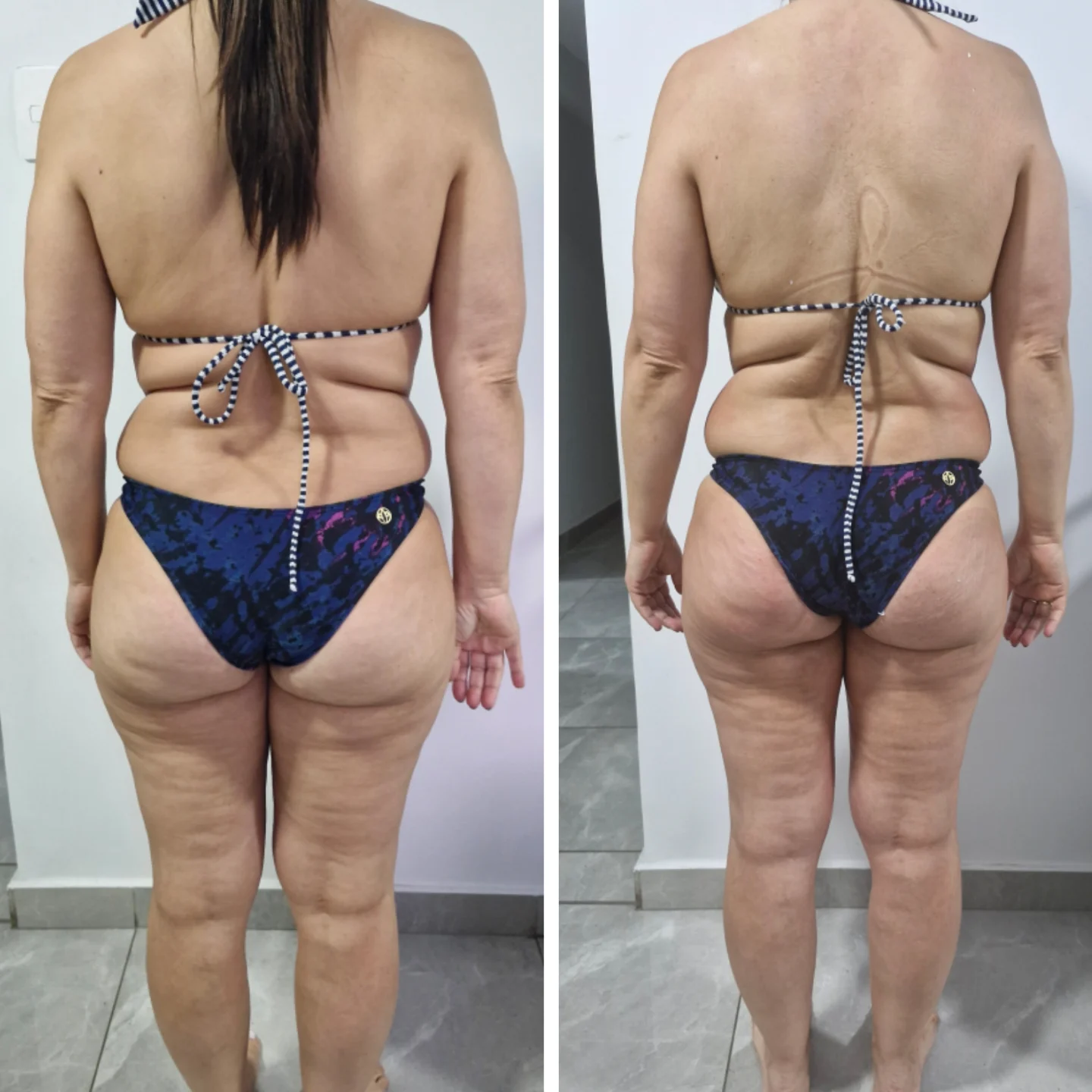 Antes e depois posterior de tratamento corporal